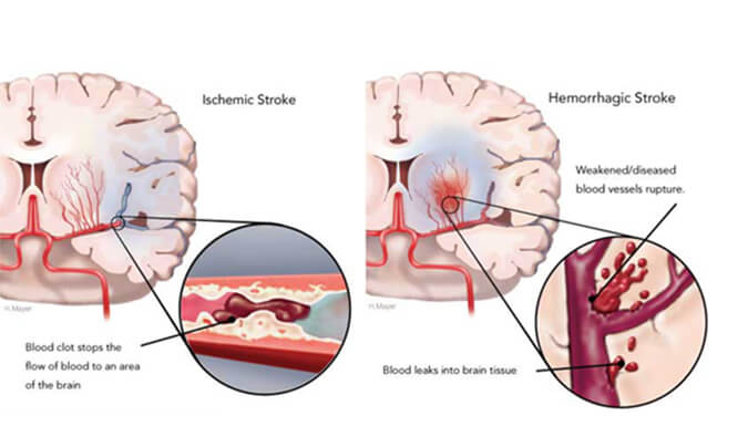 天下卒中日：从动物药效模子评价看心脑血管药物开发